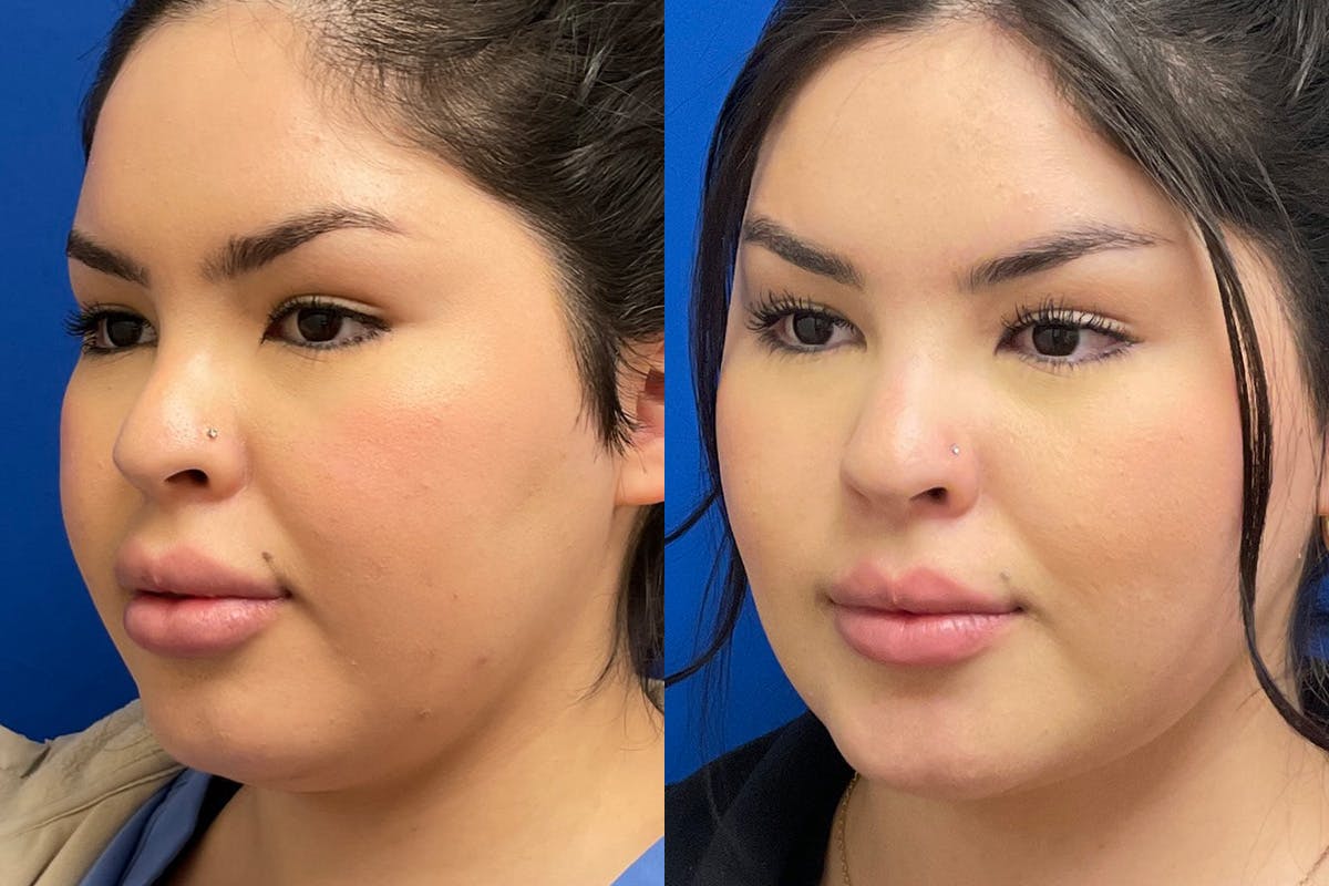 Facial Contouring / Submental Lipo Before & After Gallery - Patient 272509 - Image 4