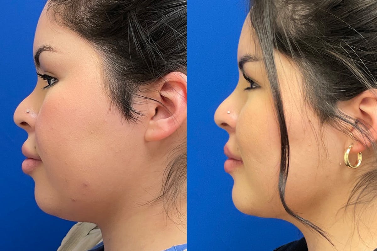 Facial Contouring / Submental Lipo Before & After Gallery - Patient 272509 - Image 5