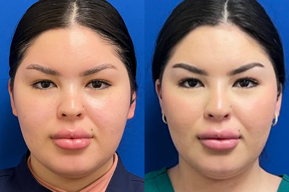 Facial Contouring / Submental Lipo Before & After Gallery - Patient 415780 - Image 3