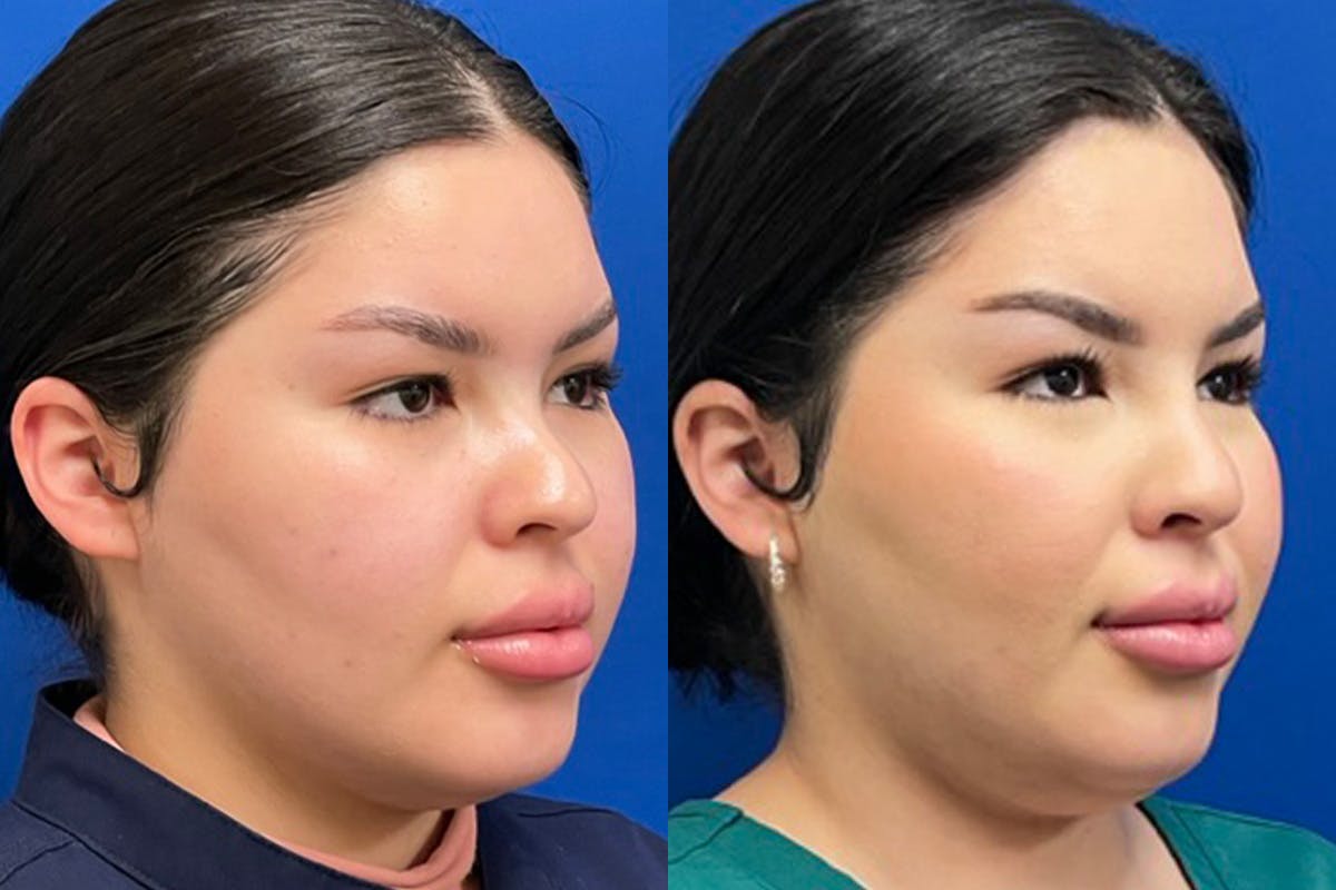Facial Contouring / Submental Lipo Before & After Gallery - Patient 415780 - Image 2