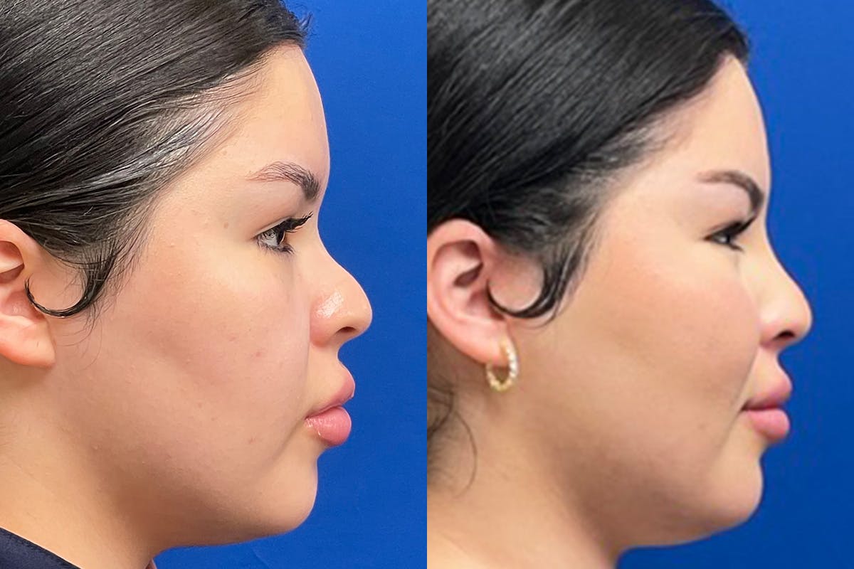 Facial Contouring / Submental Lipo Before & After Gallery - Patient 415780 - Image 1