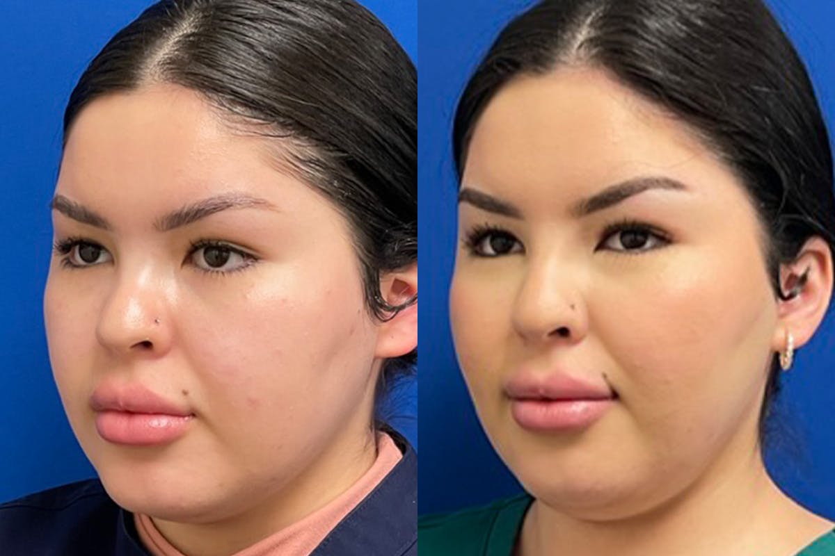 Facial Contouring / Submental Lipo Before & After Gallery - Patient 415780 - Image 4