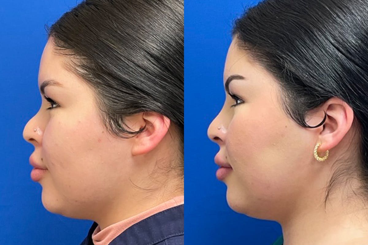 Facial Contouring / Submental Lipo Before & After Gallery - Patient 415780 - Image 5