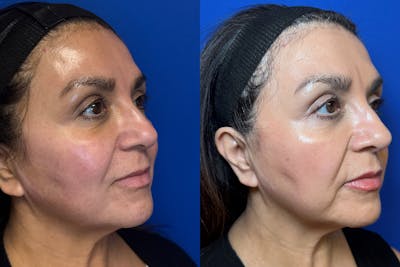 Cosmetic Dermatology Before & After Gallery - Patient 126336 - Image 1