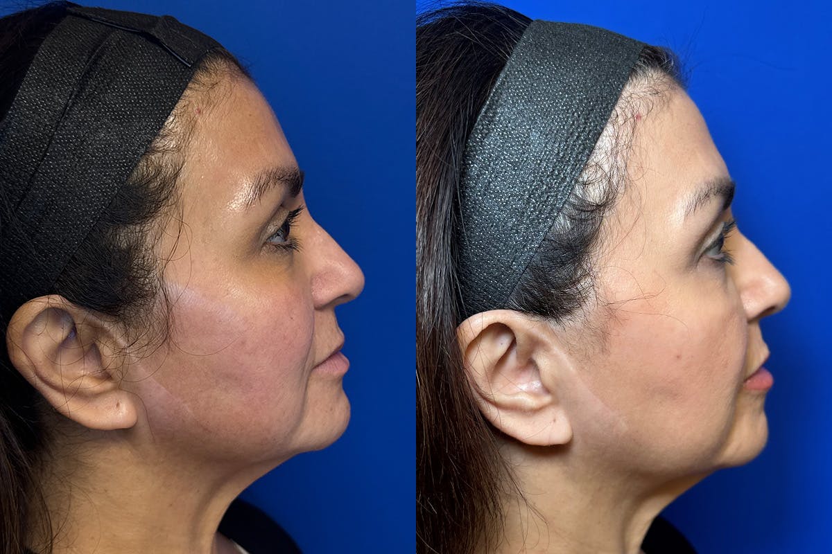 Cosmetic Dermatology Before & After Gallery - Patient 126336 - Image 2