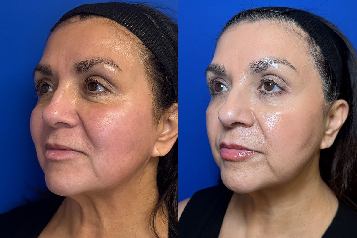 Cosmetic Dermatology Before & After Gallery - Patient 126336 - Image 3