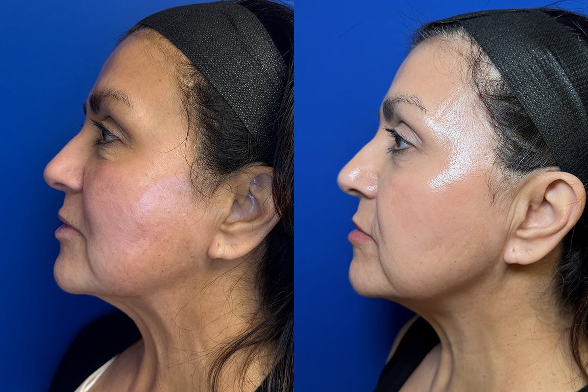 Cosmetic Dermatology Before & After Gallery - Patient 126336 - Image 4