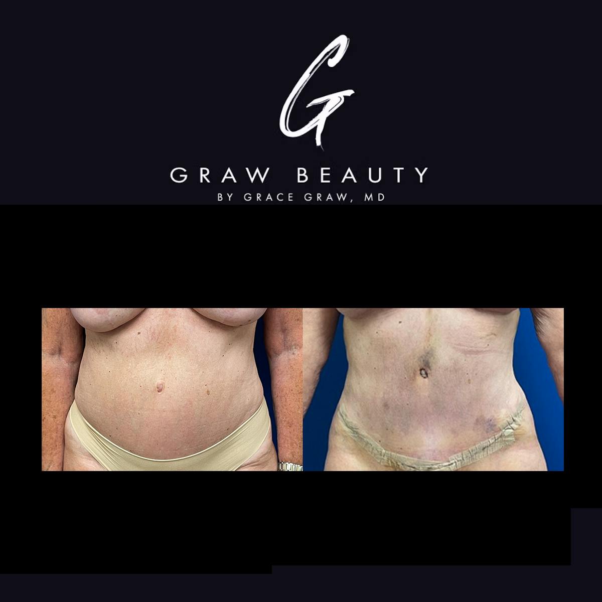 Abdominoplasty Before & After Gallery - Patient 306592 - Image 1
