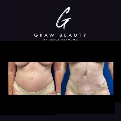 Abdominoplasty Before & After Gallery - Patient 306592 - Image 1