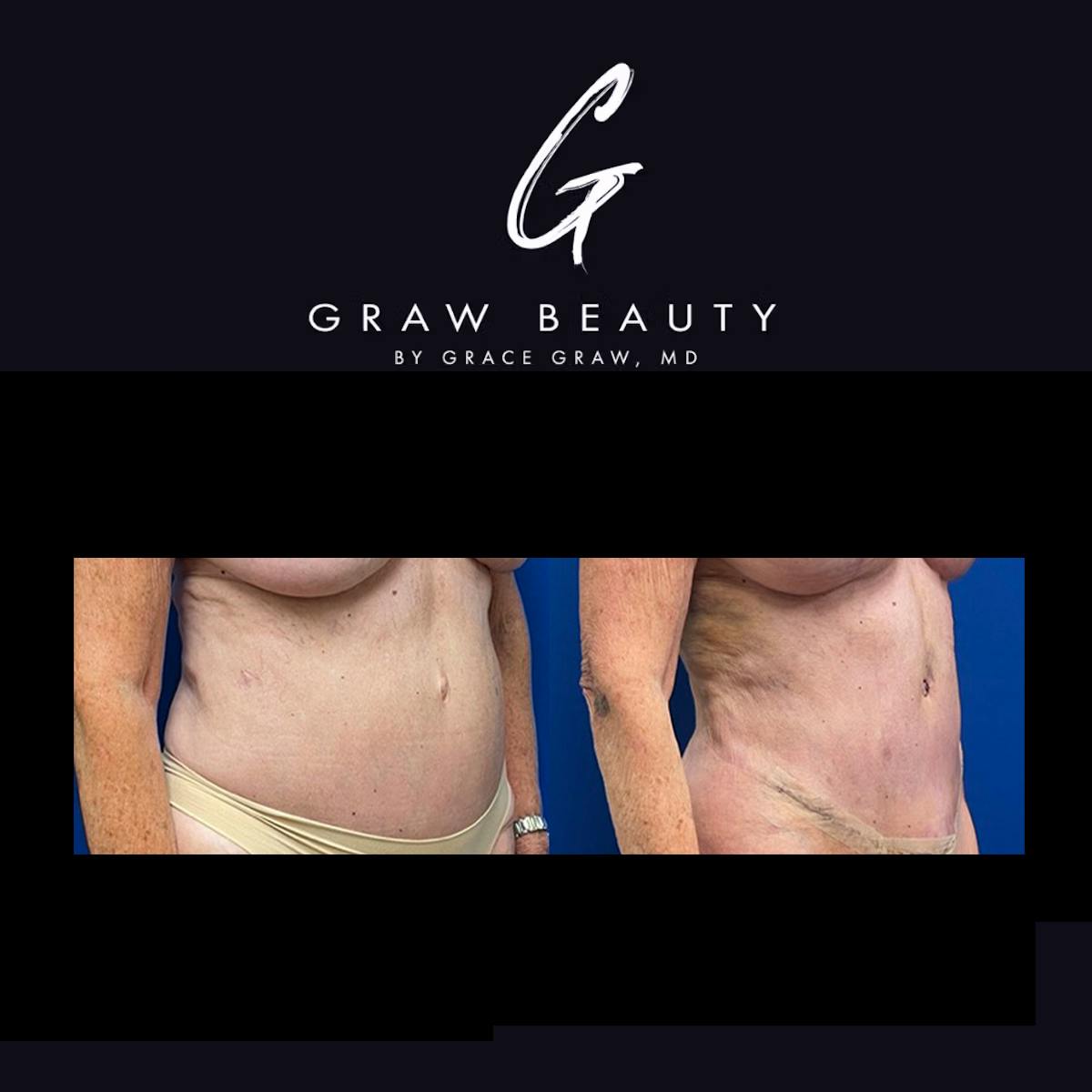 Abdominoplasty Before & After Gallery - Patient 306592 - Image 2