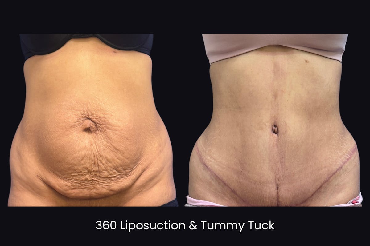 Abdominoplasty Before & After Gallery - Patient 719428 - Image 1