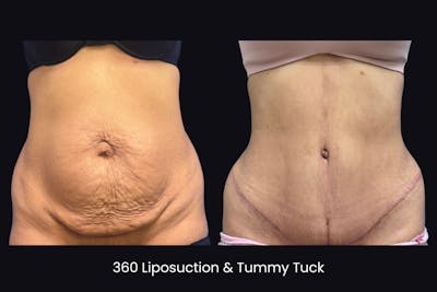 Abdominoplasty Before & After Gallery - Patient 719428 - Image 1