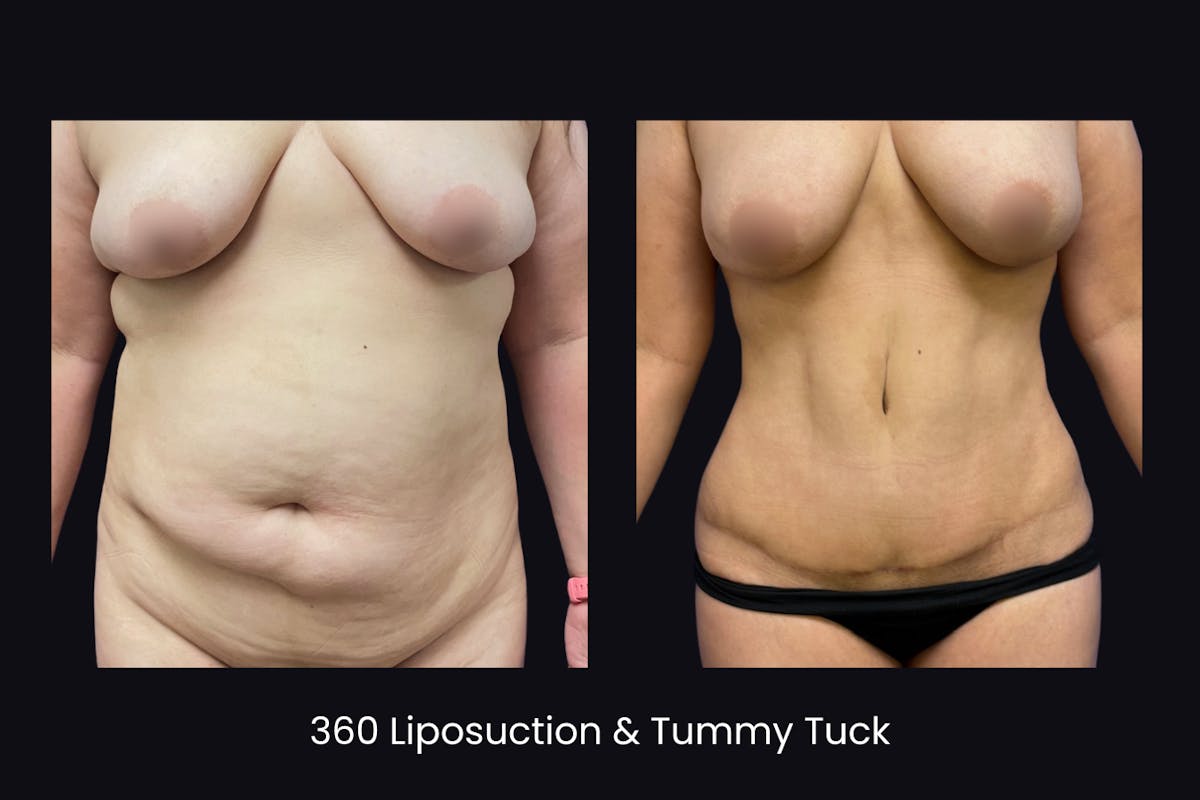 Abdominoplasty Before & After Gallery - Patient 335254 - Image 1