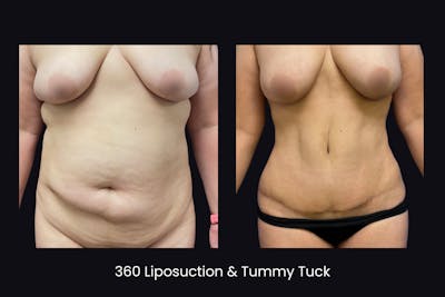 Abdominoplasty Before & After Gallery - Patient 335254 - Image 1