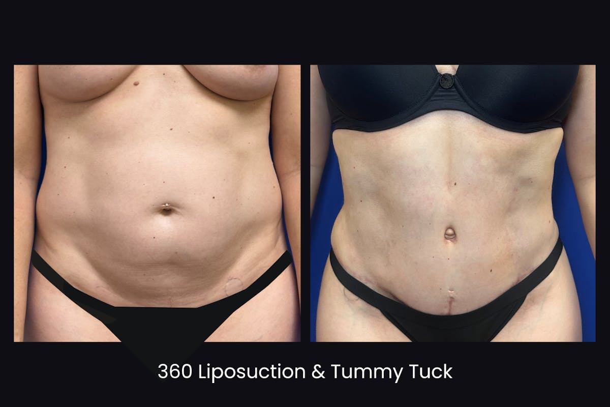 Abdominoplasty Before & After Gallery - Patient 303383 - Image 1