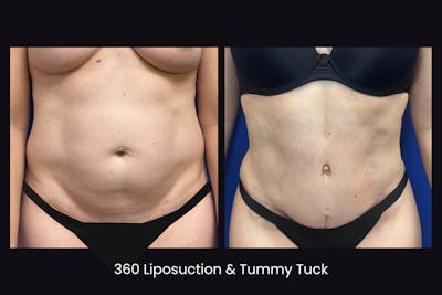 Abdominoplasty Before & After Gallery - Patient 303383 - Image 1