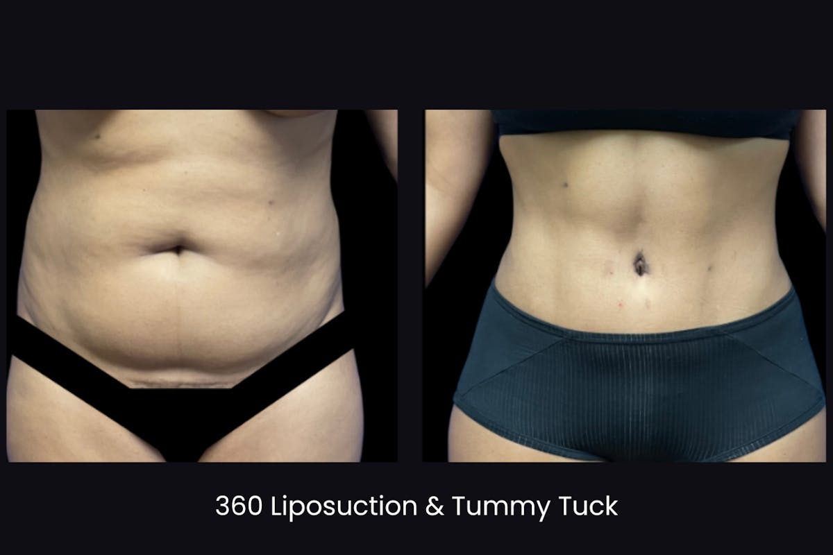 Abdominoplasty Before & After Gallery - Patient 236657 - Image 1