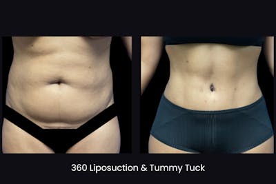 Abdominoplasty Before & After Gallery - Patient 236657 - Image 1