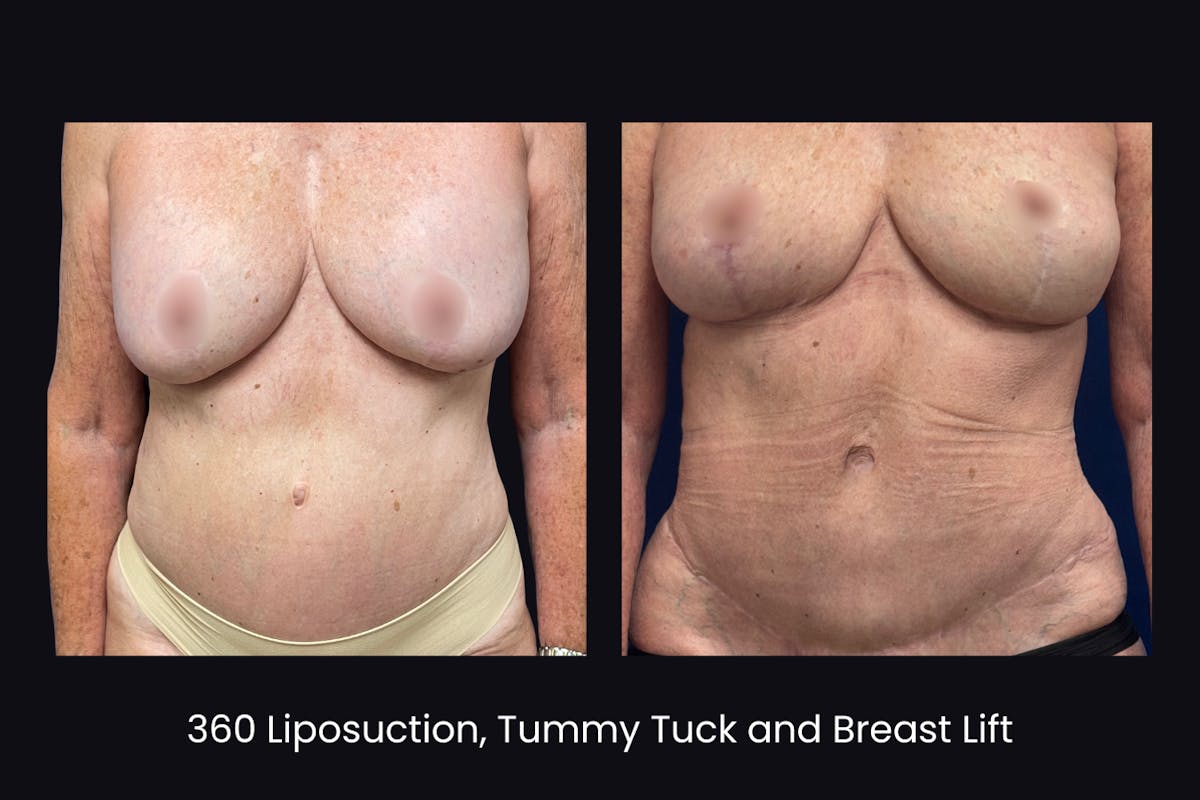 Abdominoplasty Before & After Gallery - Patient 344866 - Image 1