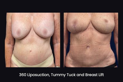 Abdominoplasty Before & After Gallery - Patient 344866 - Image 1