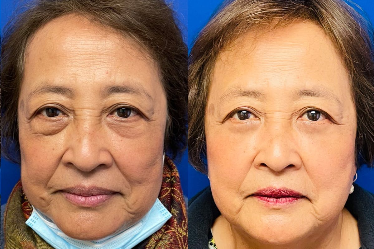 Eyelids Before & After Gallery - Patient 140792 - Image 1