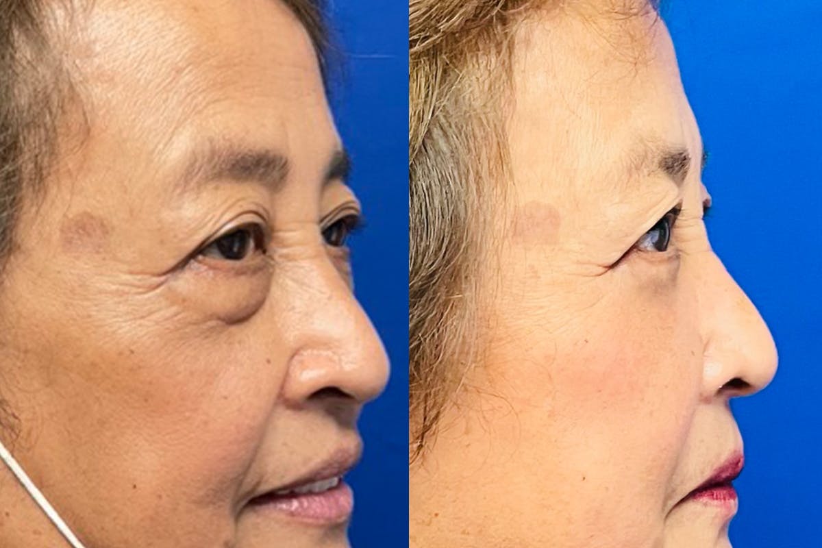 Eyelids Before & After Gallery - Patient 140792 - Image 2