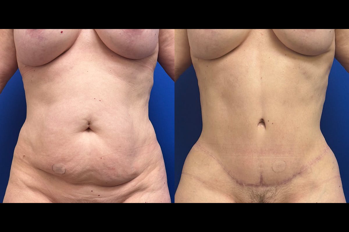 Abdominoplasty Before & After Gallery - Patient 201795 - Image 1