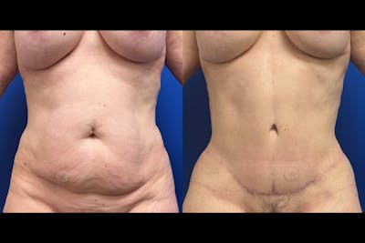 Abdominoplasty Before & After Gallery - Patient 201795 - Image 1