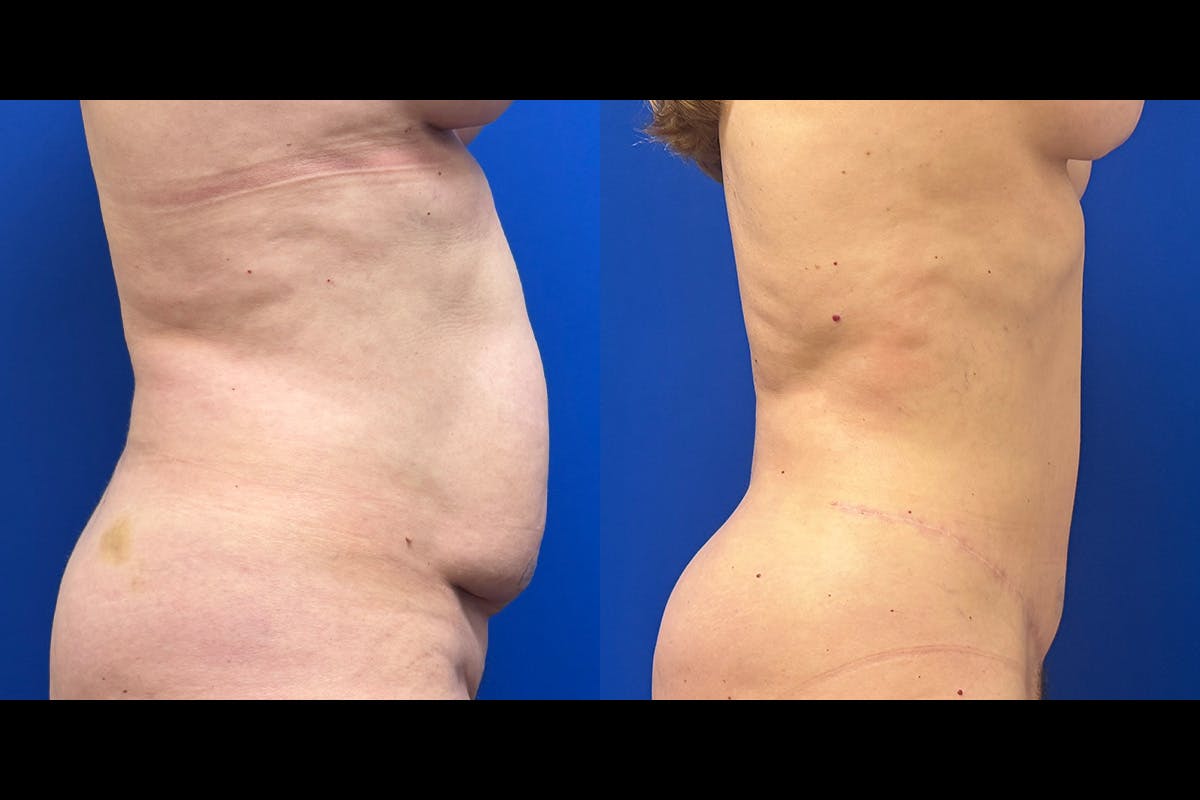 Abdominoplasty Before & After Gallery - Patient 201795 - Image 2