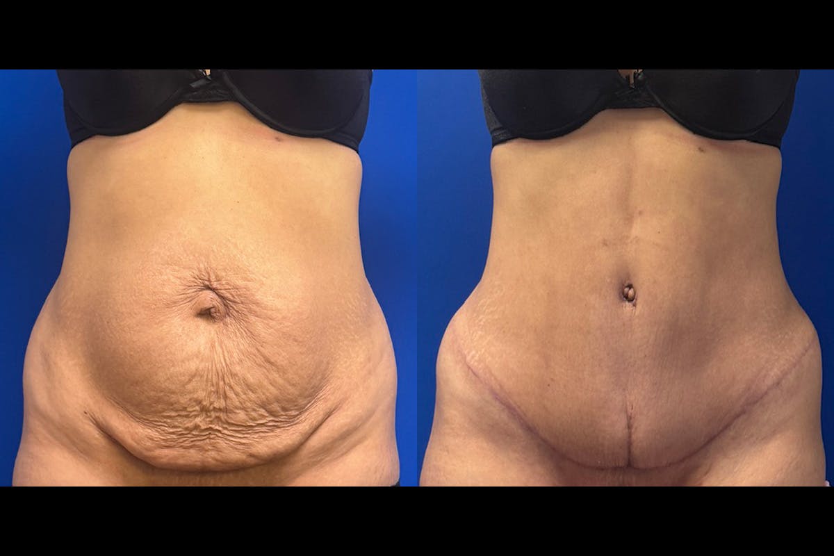 Abdominoplasty Before & After Gallery - Patient 274179 - Image 1