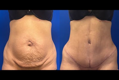 Abdominoplasty Before & After Gallery - Patient 274179 - Image 1