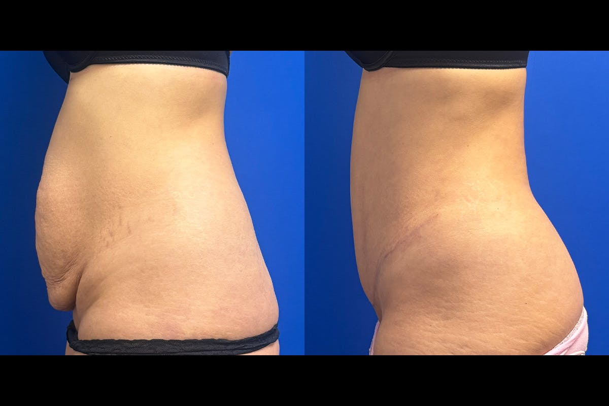 Abdominoplasty Before & After Gallery - Patient 274179 - Image 2