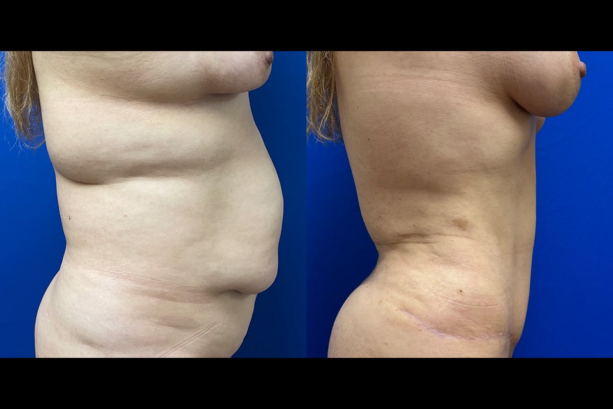 Abdominoplasty Before & After Gallery - Patient 157614 - Image 2