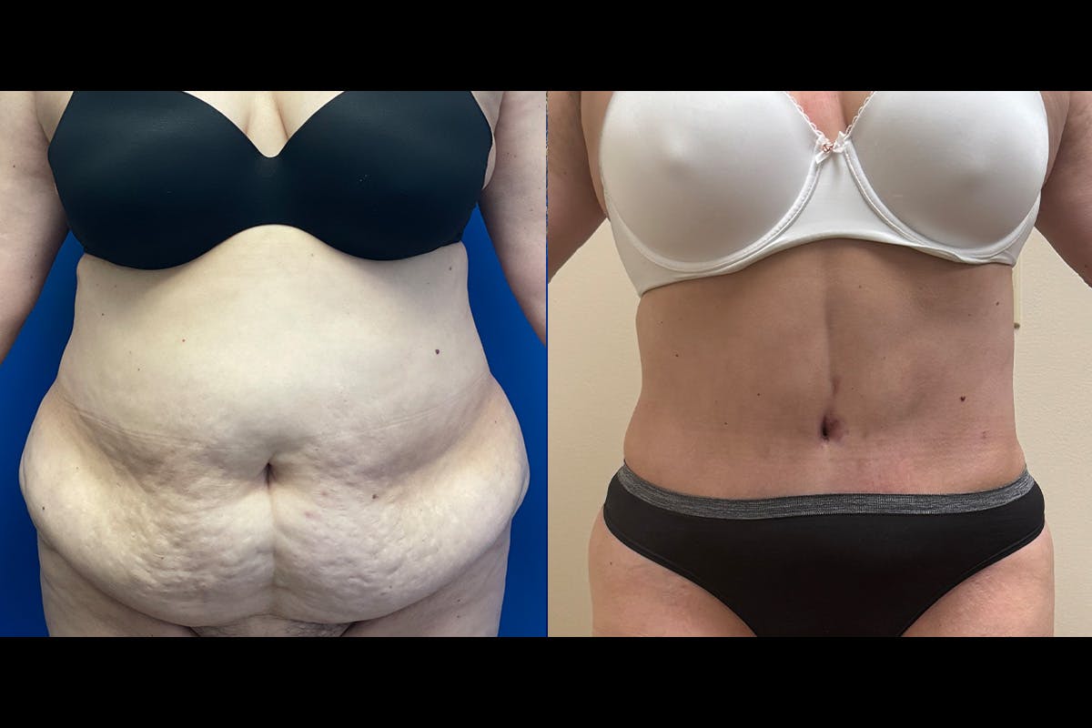 Abdominoplasty Before & After Gallery - Patient 317069 - Image 1