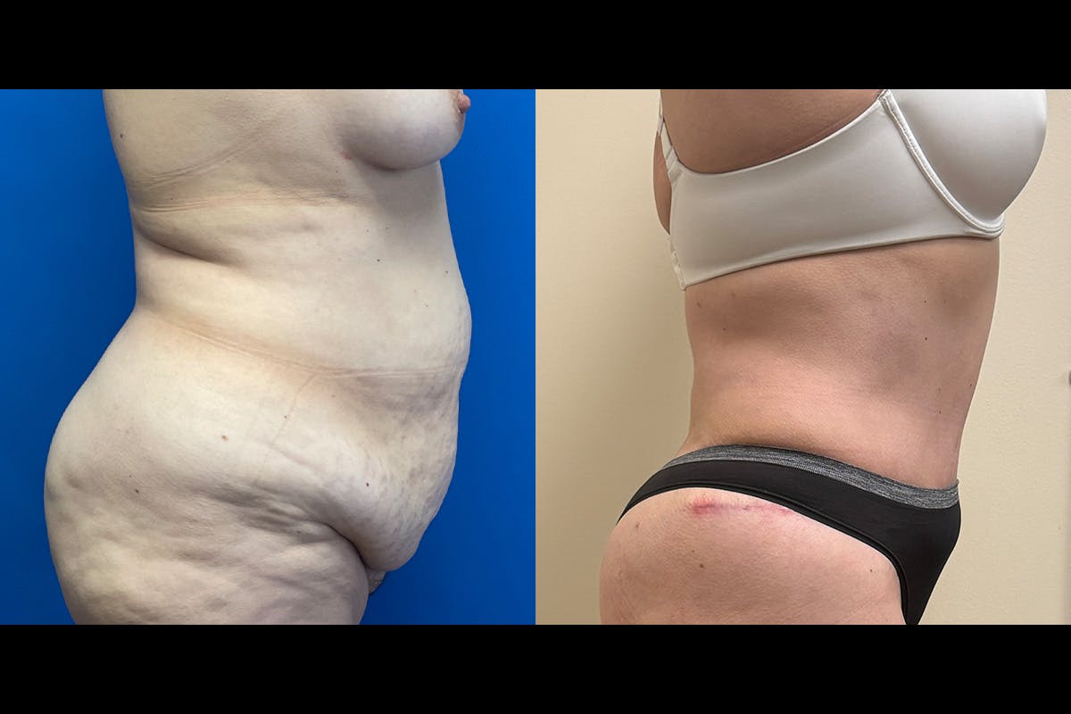 Abdominoplasty Before & After Gallery - Patient 317069 - Image 2