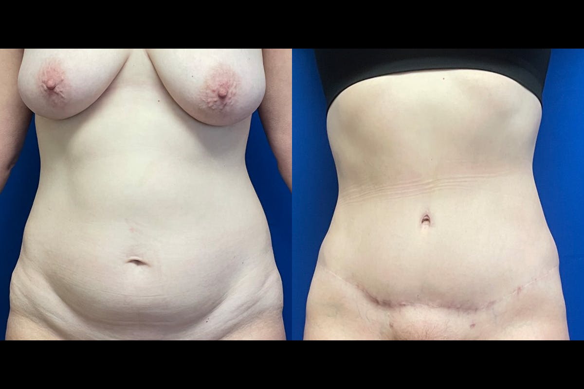 Abdominoplasty Before & After Gallery - Patient 175638 - Image 1