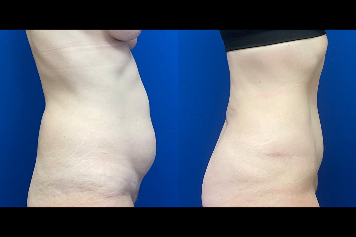 Abdominoplasty Before & After Gallery - Patient 175638 - Image 2