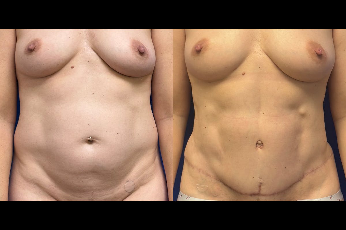 Abdominoplasty Before & After Gallery - Patient 345097 - Image 1