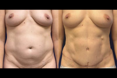 Abdominoplasty Before & After Gallery - Patient 345097 - Image 1