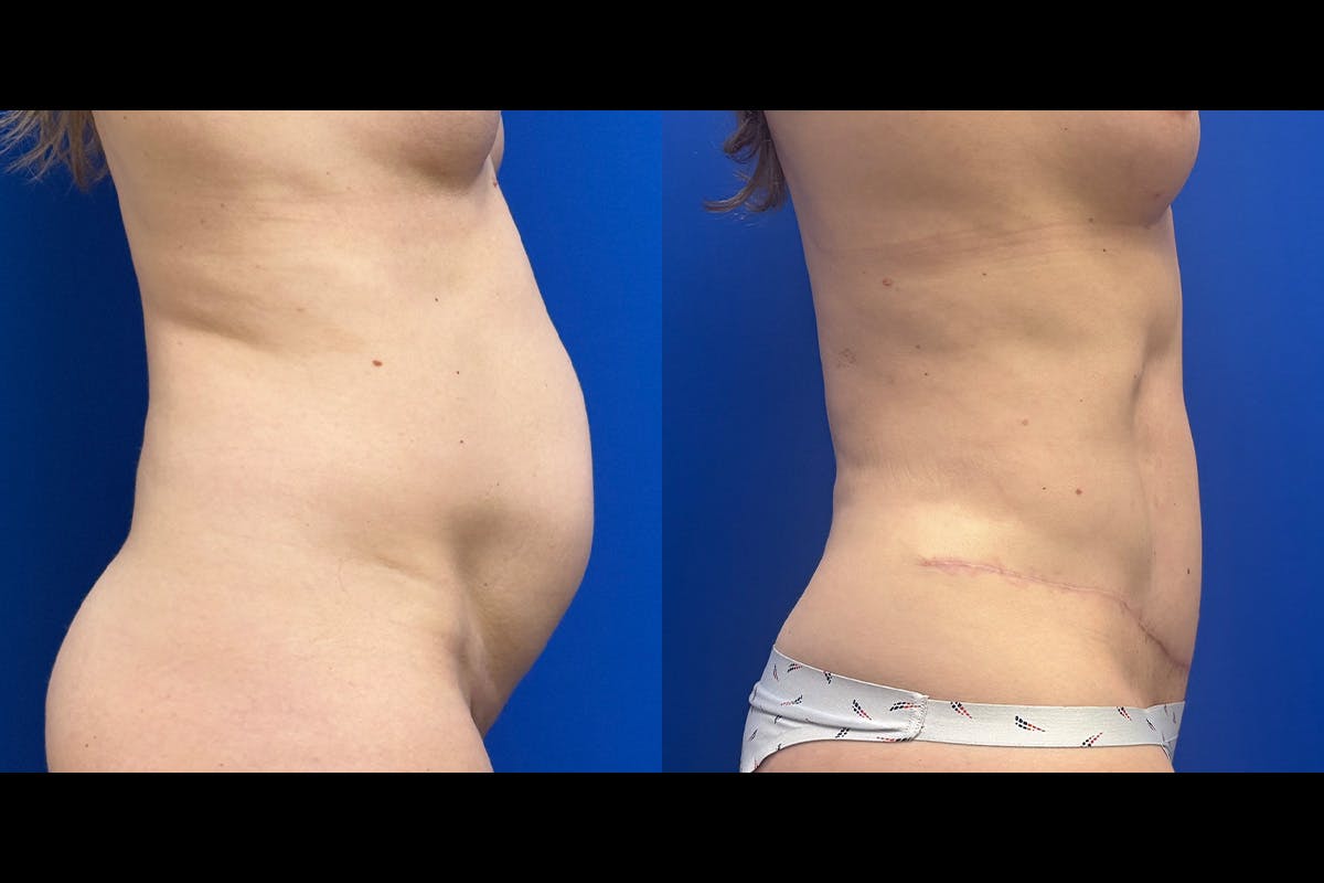 Abdominoplasty Before & After Gallery - Patient 345097 - Image 2