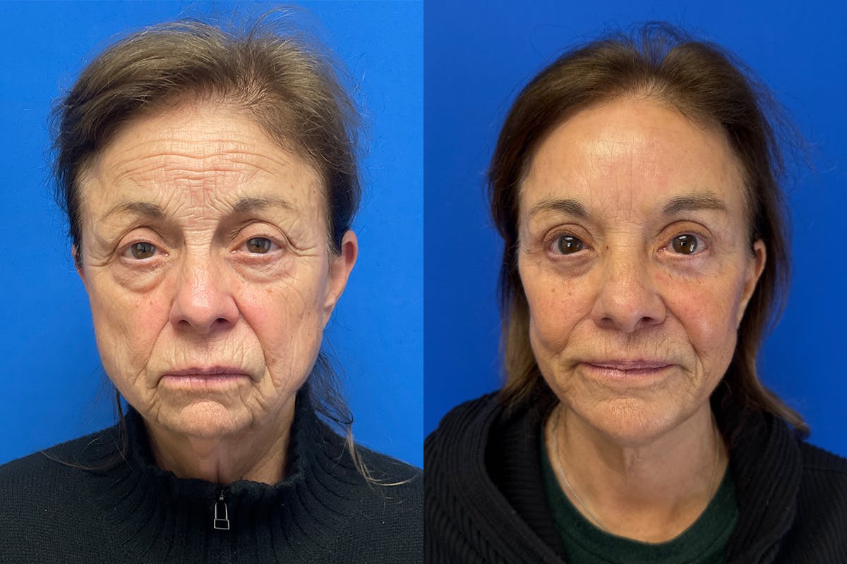 Facelift Before & After Gallery - Patient 419258 - Image 1