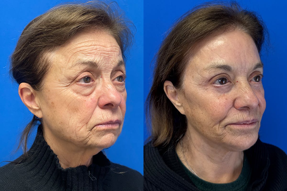 Facelift Before & After Gallery - Patient 419258 - Image 3