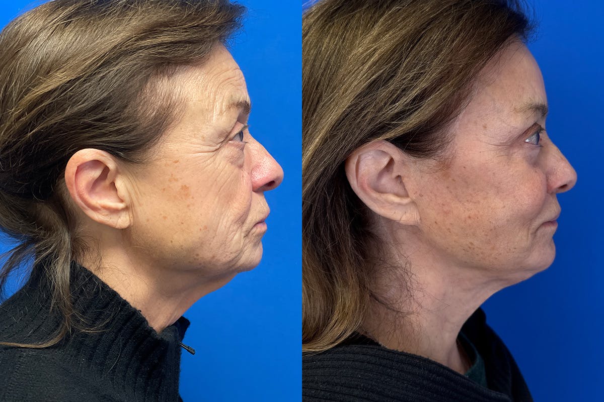 Facelift Before & After Gallery - Patient 419258 - Image 2