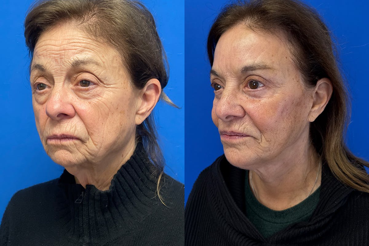 Facelift Before & After Gallery - Patient 419258 - Image 4