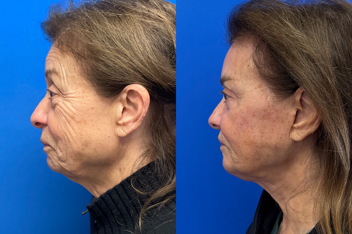 Facelift Before & After Gallery - Patient 419258 - Image 5