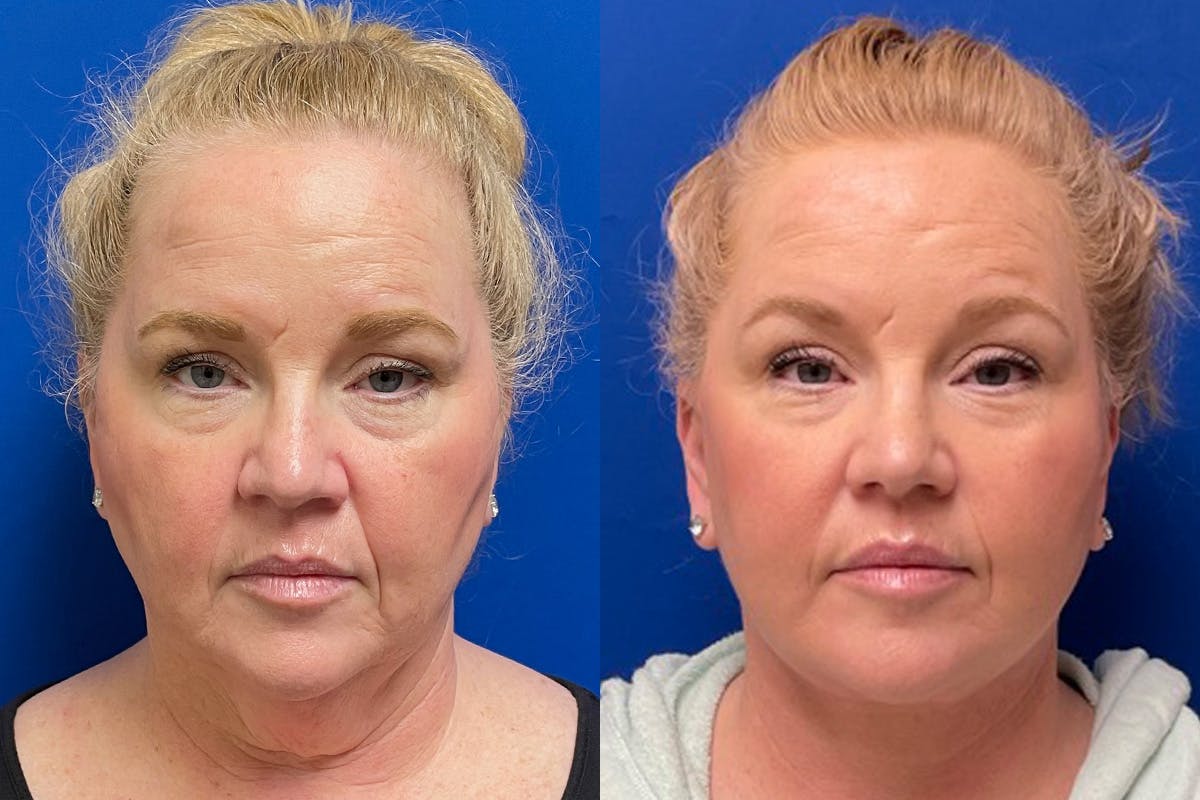 Facelift Before & After Gallery - Patient 391223 - Image 1