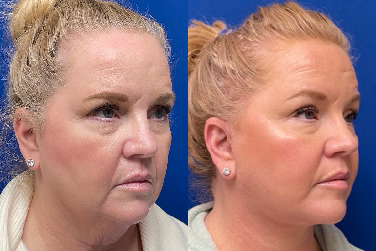 Facelift Before & After Gallery - Patient 391223 - Image 2