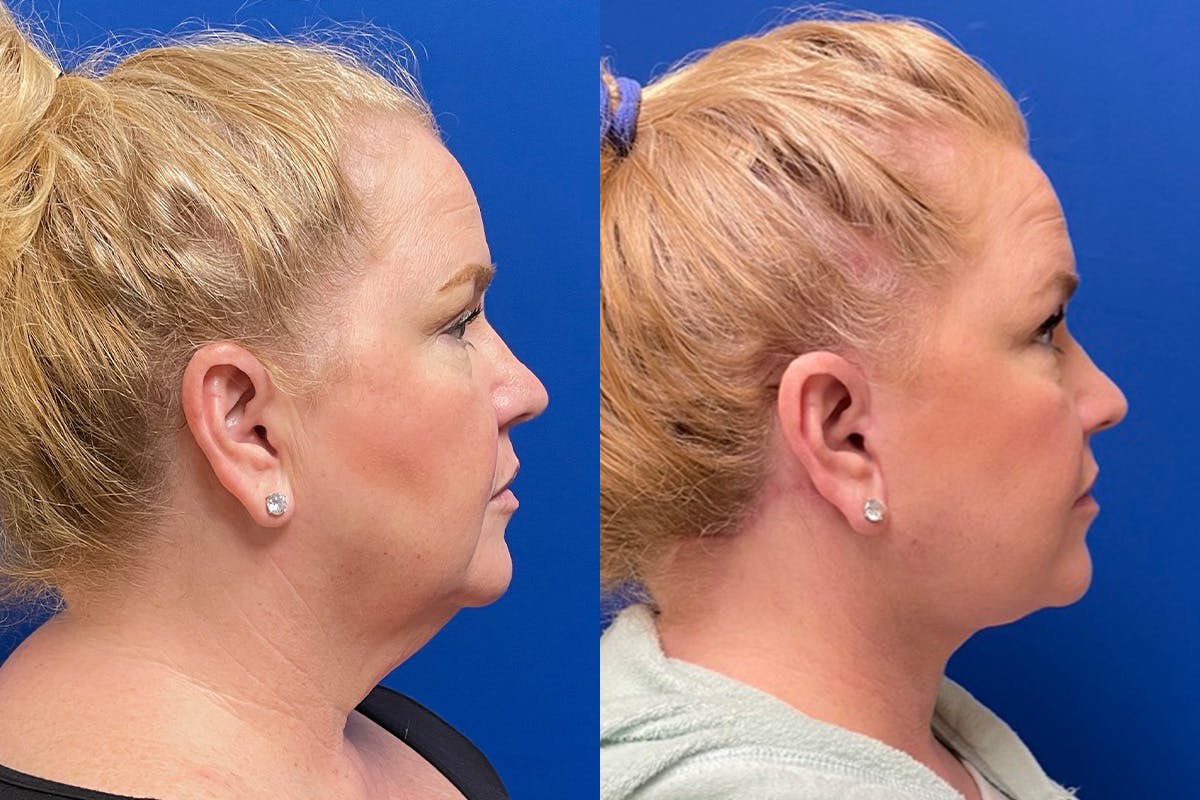 Facelift Before & After Gallery - Patient 391223 - Image 3