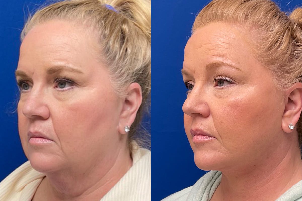 Facelift Before & After Gallery - Patient 391223 - Image 4
