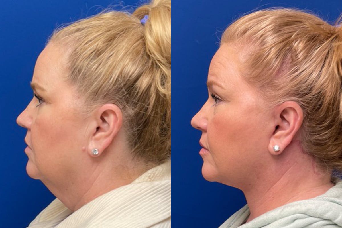 Facelift Before & After Gallery - Patient 391223 - Image 5